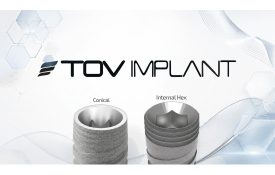 Bien choisir son système d’implants : les critères essentiels